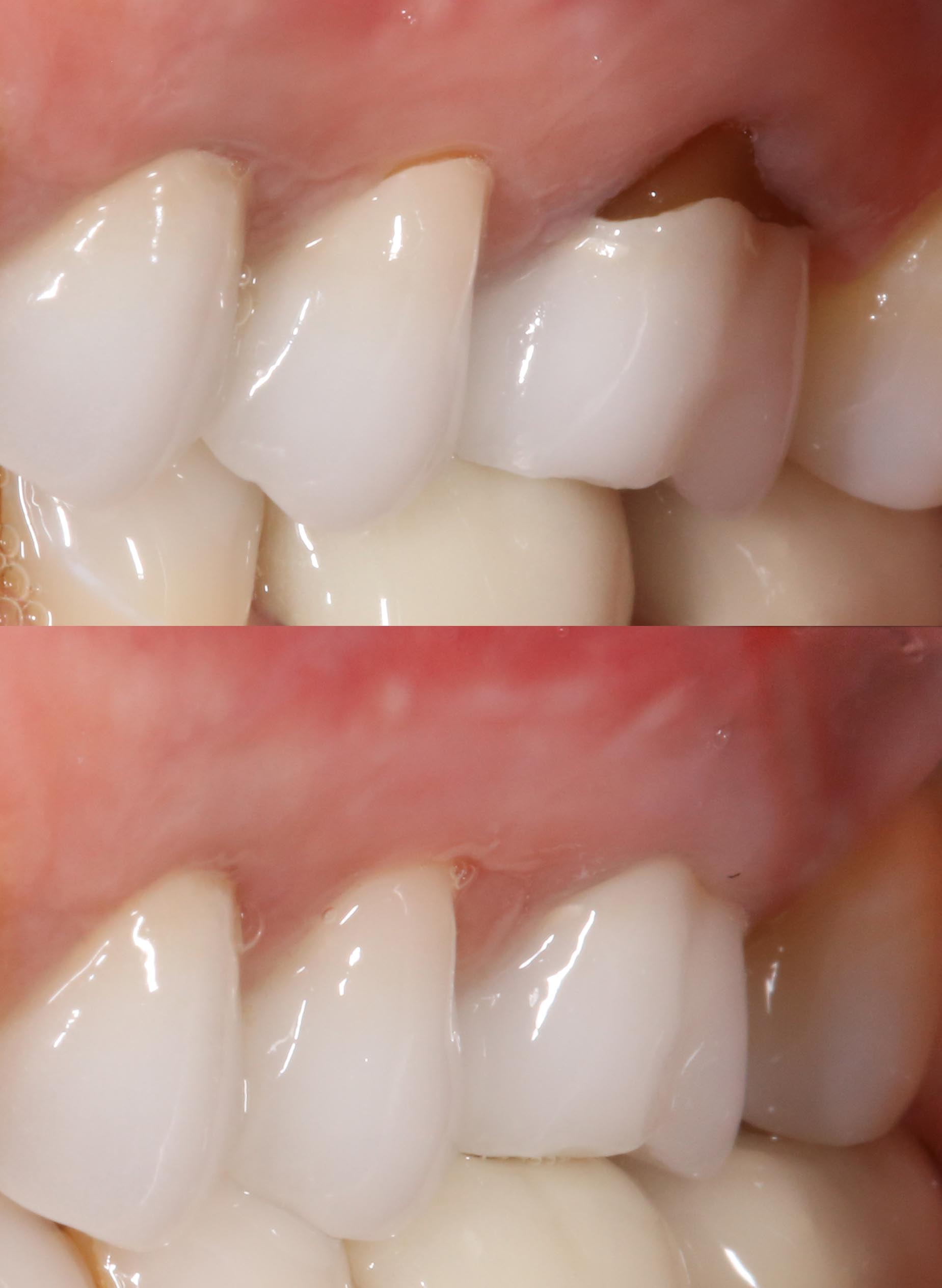 chao pinhole gum graft before and after